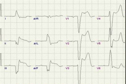 Нижний инфаркт миокарда на фоне блокады ЛНПГ