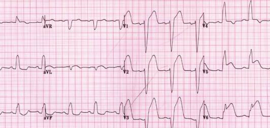 Инфаркт миокарда на фоне блокады ЛНПГ
