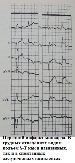 Элевация сегмента S-T при правожелудочковой стимуляции при инфаркте миокарда