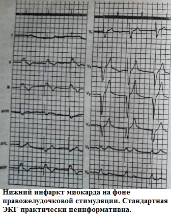 Инфаркт миокарда на фоне кардиостимулятора