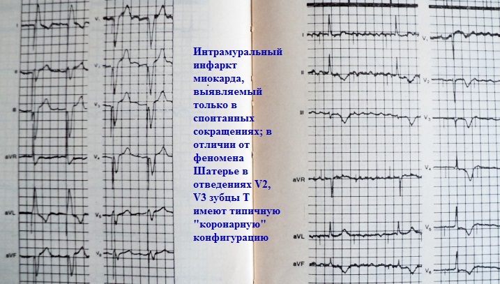 Инфаркт миокарда на фоне кардиостимуляции