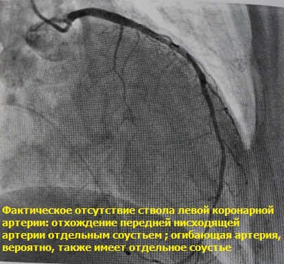 Аномалия развития коронарной артерии
