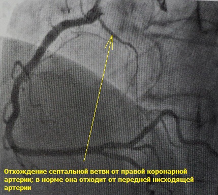 Аномалия развития коронарной артерии
