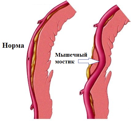 Мышечный мостик коронарной артерии